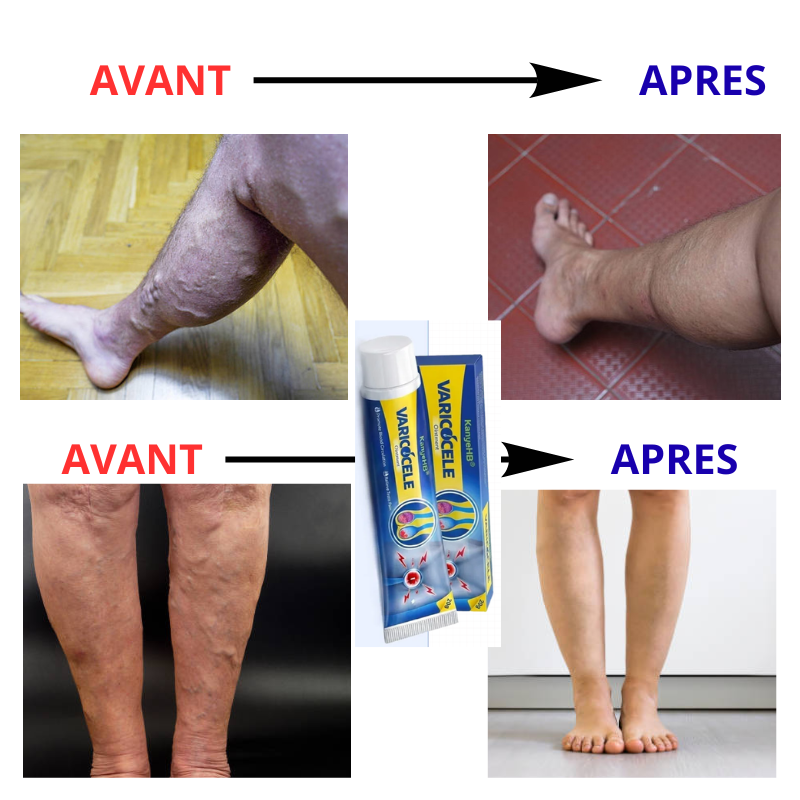 Crème de Massage Thérapeutique contre Varicocèle
